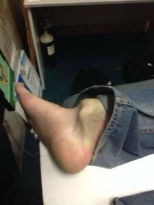 Shunter's ankle after his collision 